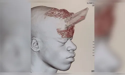 Pedreiro sofre acidente de trabalho e fica com estaca presa ao crânio