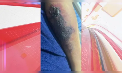 Após ser picado por aranha-marrom, turista morre em viagem na Bahia