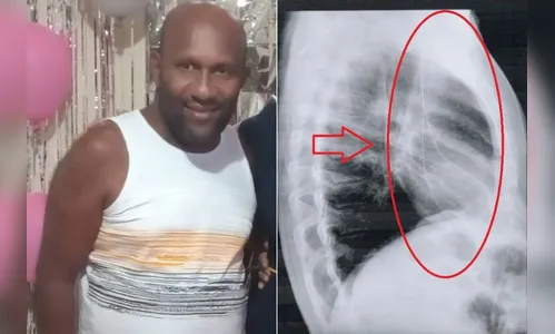 Médico esquece instrumento entre o pescoço e coração de paciente