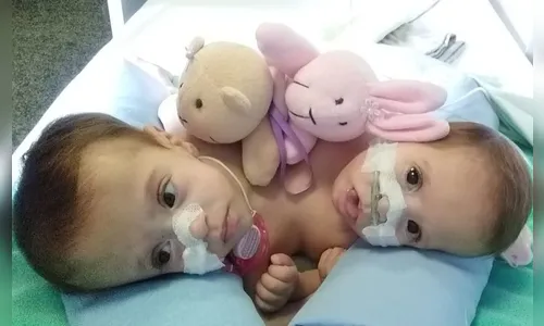Morrem siamesas que nasceram unidas pelo tórax e abdômen