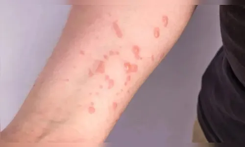 22ª Regional de Saúde registra o primeiro caso de Mpox em Ivaiporã