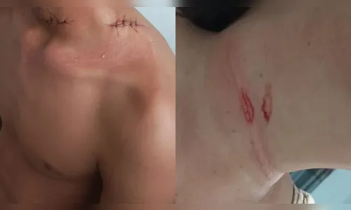 Mulher e criança ficam feridas em acidente com linha de pipa no Paraná