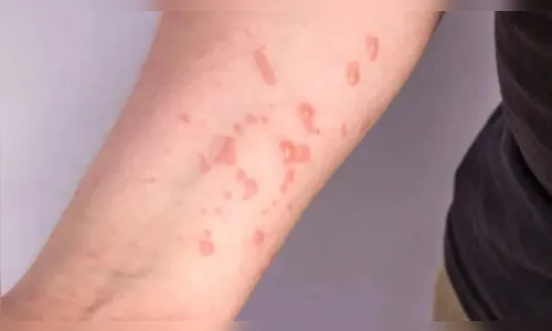 Brasil supera marca de mil casos de mpox em 2024