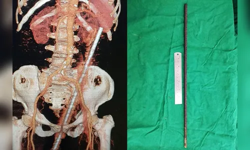 Idosa escorrega em pasto e é empalada por barra de metal enferrujada