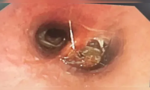 Homem fica com bafo de barata após aspirar inseto enquanto dormia