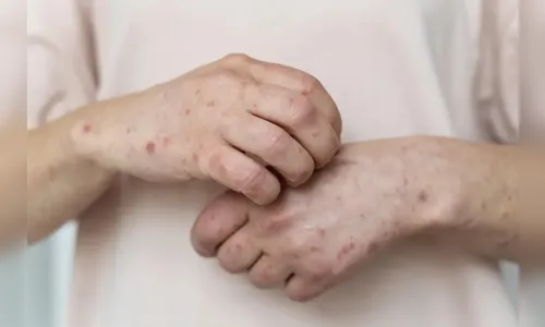 Arapongas e Ivaiporã registram casos de Mpox, diz boletim de Sesa