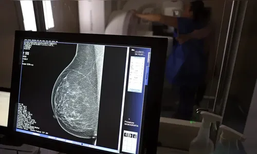 Cerca de 77 mil mulheres aguardam mamografia pelo SUS