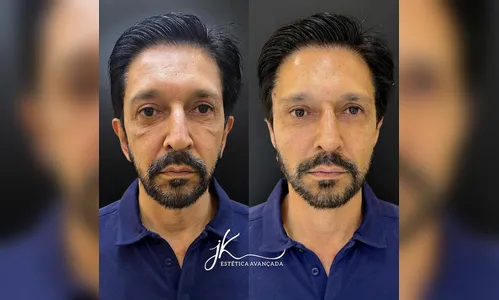 Ricardo Nunes, prefeito reeleito em SP, faz harmonização e viraliza