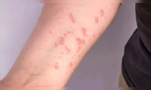 Brasil já contabiliza mais de 1,5 mil casos de mpox em 2024