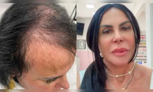 Gretchen exibe resultado de tratamento capilar contra alopecia; veja