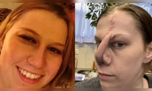 Mulher perde nariz cheirando cocaína e médico refaz com pele da testa