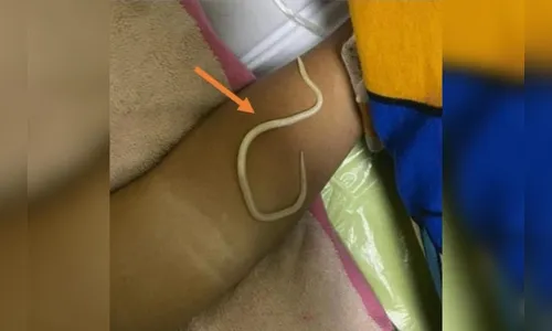 Menino é diagnosticado com constipação mas horas depois vomita vermes