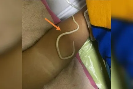 A radiografia revelou áreas opacas no intestino, compatíveis com obstrução intestinal