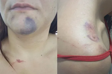 Além de ser enforcada, ela também recebeu socos, chutes e puxões de cabelo