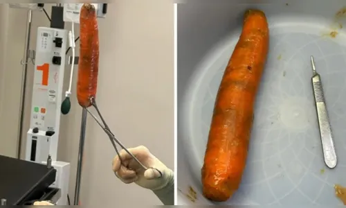 Cenoura de 20 cm encontrada no ânus de homem deixa médicos chocados