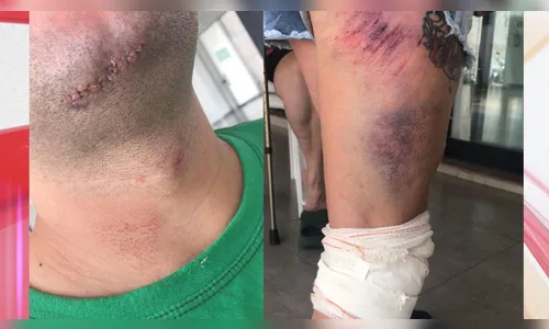 Motociclista e passageira ficam feridos após colisão com carro