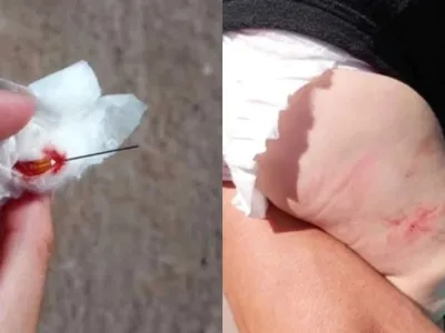 Um bebê de quatro meses ficou com uma agulha cravada na perna