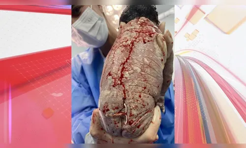 Milagre? Bebê nasce com DIU grudado no bumbum e choca equipe médica