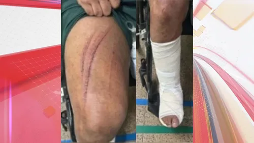 Garoto de programa quebrou a perna