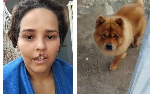 Natani Santos, de 35 anos, passará por cirurgia de reconstrução do lábio