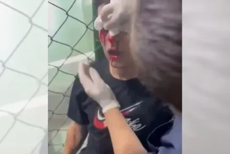 Uma bomba atirada no vestiário acabou vitimando o jogador Daniel Pacheco, de 19 anos, tendo perfurado o globo ocular do atleta