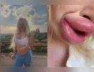Influencer não consegue mais fechar a boca após preenchimentos labiais