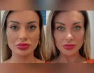 Arrependida, Andressa Urach reclama de dor após mudar cor dos olhos