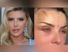 Íris Stefanelli surge com o rosto inchado após cirurgia plástica