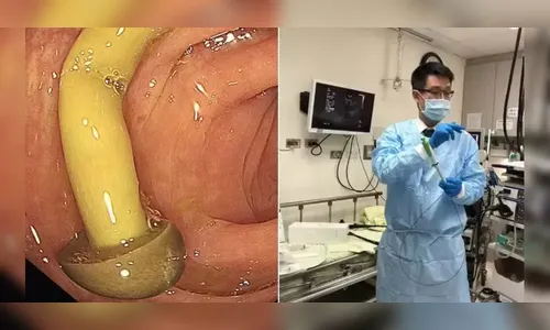 Médico encontra cogumelo crescendo em intestino de paciente; entenda