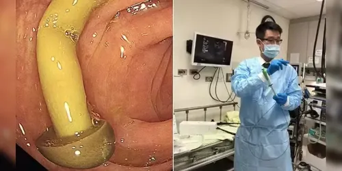 Cogumelo enoki foi encontrado por gastroenterologista durante procedimento