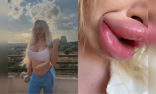 Influencer não consegue mais fechar a boca após preenchimentos labiais