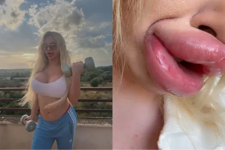 Ela revelou que compromete sua qualidade de vida
