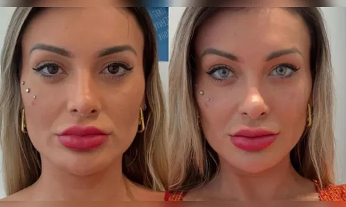Arrependida, Andressa Urach reclama de dor após mudar cor dos olhos