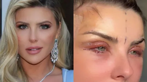 Nos stories do Instagram, a loira mostrou o rosto inchado e as cicatrizes ao redor dos olhos