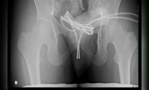 Homem é internado após enfiar cabo USB no pênis e objeto ficar preso