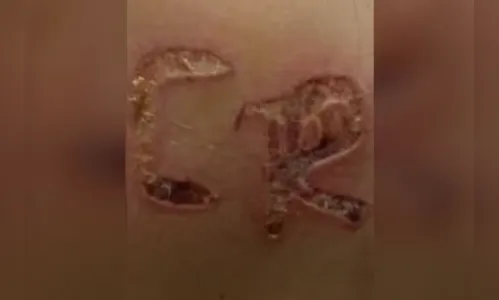 Homem é preso por marcar iniciais do nome na esposa com ferro quente