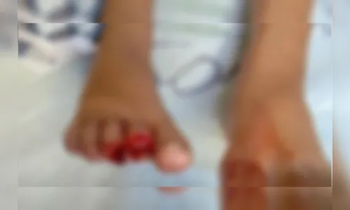 Criança de 9 anos tem dedos dos pés arrancados por piranhas