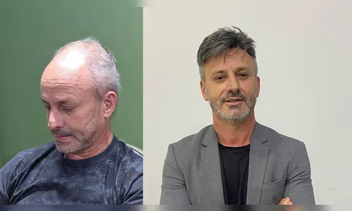 “Trabalho com audiovisual, e o visual é muito importante. Me sentia muito mal. Hoje sei que era bullying o que eu sofria quando me chamavam de careca.”, desabafa Cézar Neves