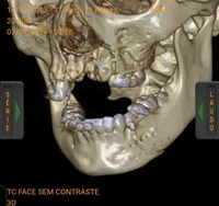 Cirurgia 3D restaura o rosto de criança vítima de atropelamento no PR