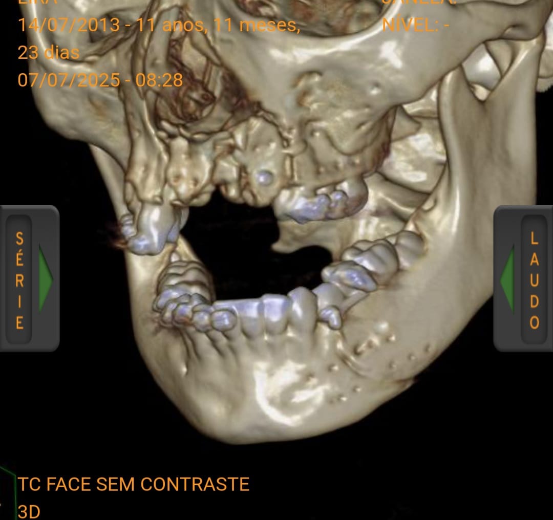 Cirurgia 3D restaura o rosto de criança vítima de atropelamento no PR