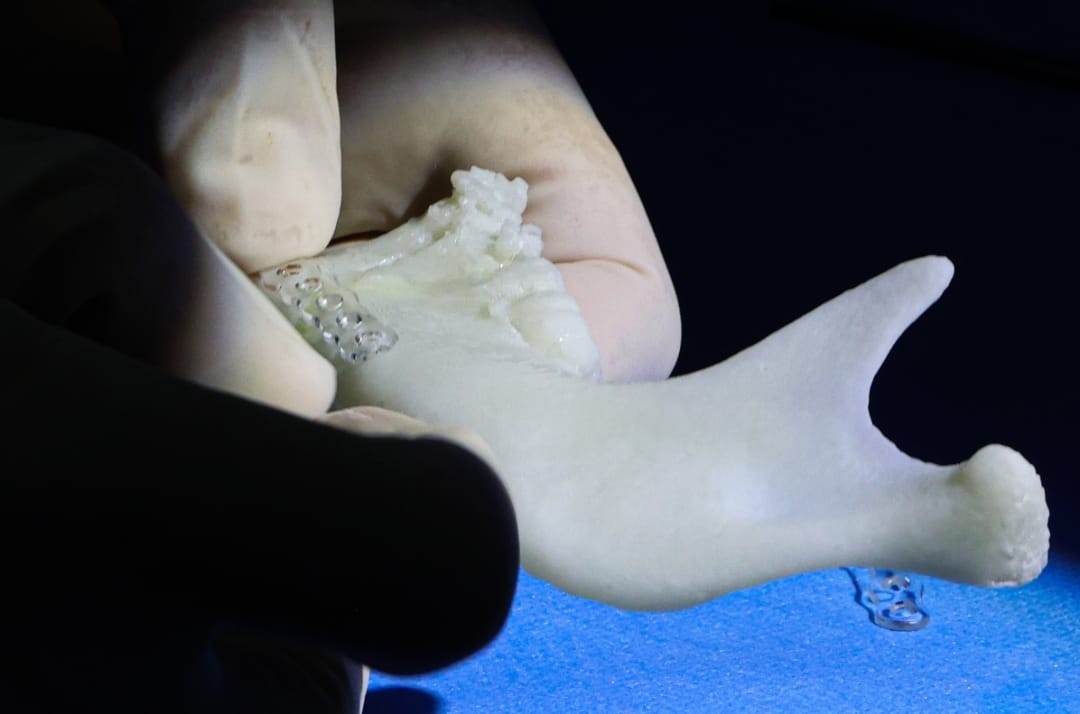 Cirurgia 3D restaura o rosto de criança vítima de atropelamento no PR