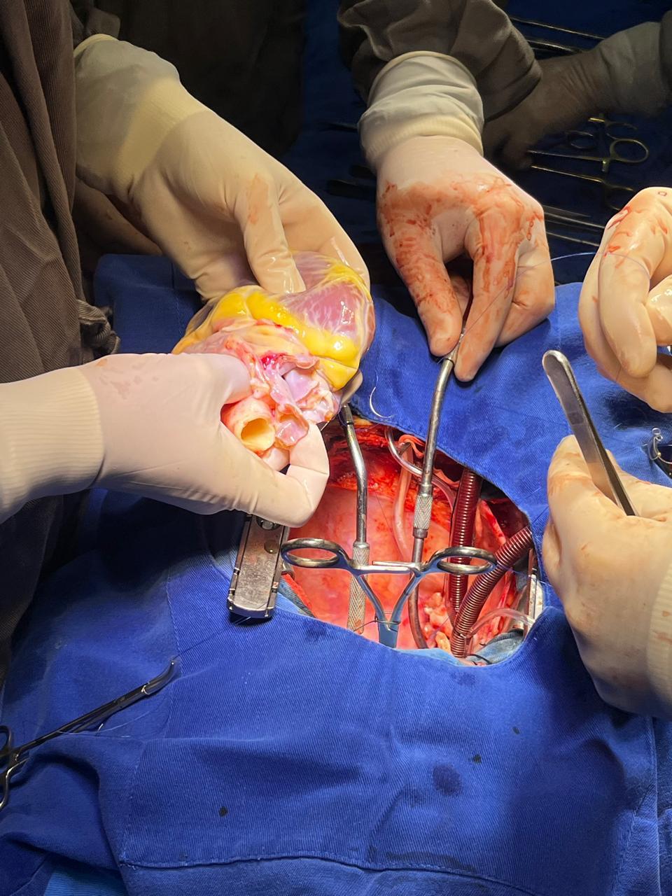 Hospital Honpar realiza primeiro transplante de coração em Arapongas
