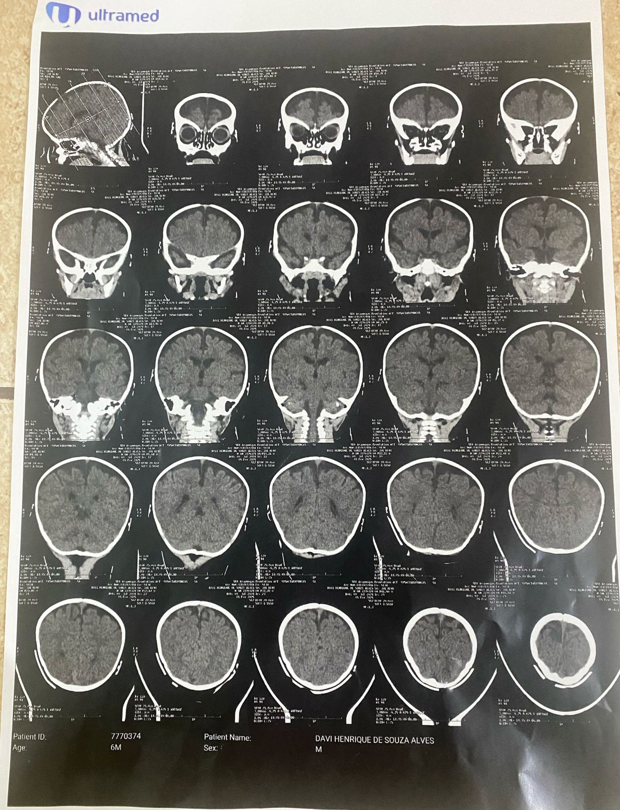 Resultado da tomografia