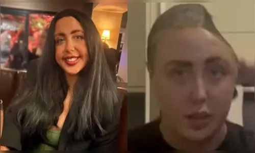 Jovem cai de escada bêbada e perde parte do crânio; entenda