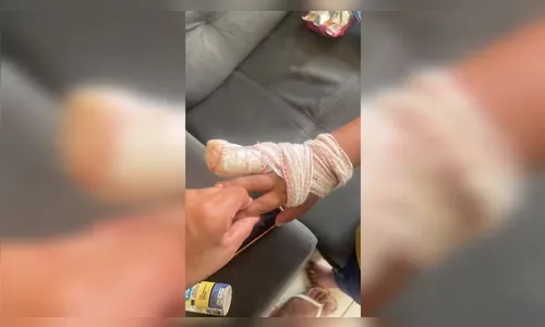 Criança perde parte do dedo após ter a mão prensada em porta de creche