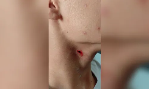 Aluno de 15 anos ataca colega com caneta no pescoço dentro de colégio no PR