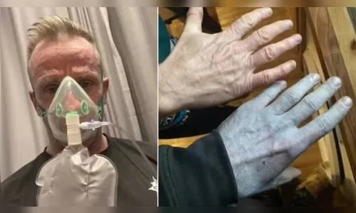 Homem se assusta ao acordar com pele azulada e diagnóstico surpreende