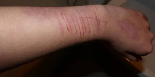 Um em cada três adolescentes relata 'vontade de se machucar de propósito', aponta pesquisa