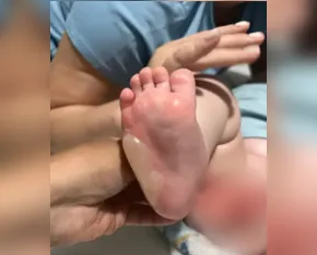 Bebê de 7 meses sofre queimaduras de segundo grau durante banho em berçário
