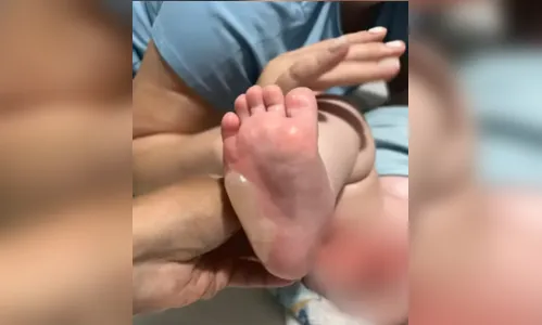 Bebê de 7 meses sofre queimaduras de segundo grau durante banho em berçário